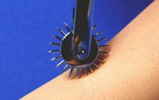 Wartenberg wheel in use